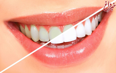 سفیدکننده های خانگی برای سفید کردن دندان‌ها در نوروز