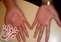 علائم و نشانه های سرطان در دست را می دانید ؟