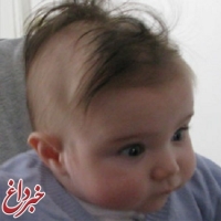 علت ریزش موی کودک چیست؟