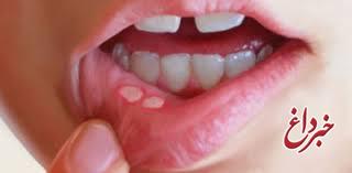 درمان آفت دهان با روش‌های خانگی و گیاهی