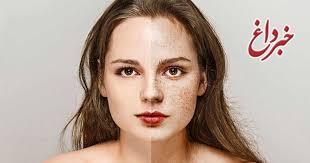 درمان لک پوست با نسخه طبیعی