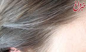 سفید شدن مو در سنین زیر ۴۰ سال بیماری است