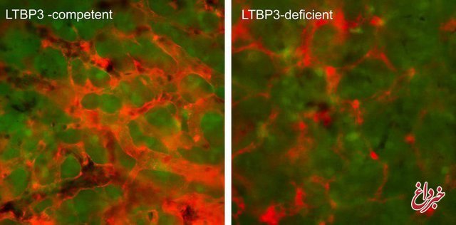 شناسایی یک پروتئین برای مبارزه با گسترش سلول‌های سرطانی