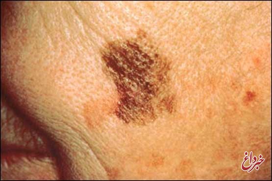 4 عاملی که احتمال ابتلا به سرطان پوست را افزایش می‌دهد