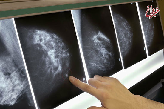 تشخیص سرطان پستان پنج سال زودتر از ابتلا!