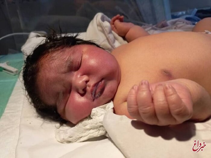 تولد نوزادی با ۶.۵ کیلوگرم وزن در مشهد
