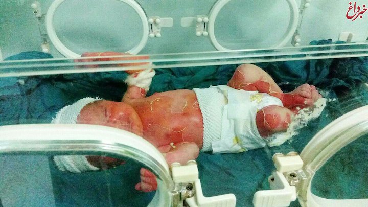 خبر سوختگی نوزاد 3 روزه تایید شد