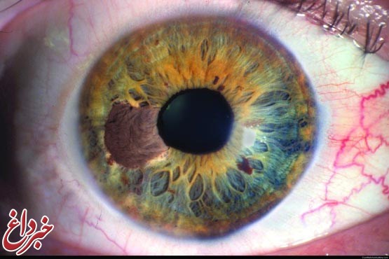 چشم تو چشم سرطان