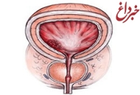 خودارضایی خطر سرطان پروستات را افزایش می‌دهد