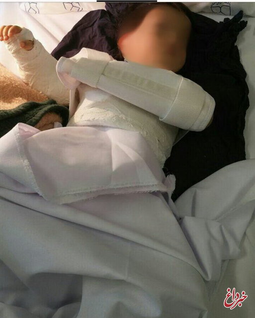 پاسخ دانشگاه علوم پزشکی اصفهان در پی جراحی اشتباه دست کودک 2 ساله