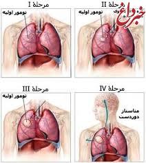 تشخیص سرطان ریه با آزمایش ساده تنفس