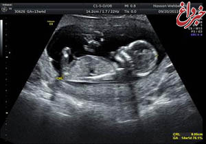 حد و مرزهای سونوگرافی بارداری/بیشتر از 4 بار دیدن جنین ممنوع!
