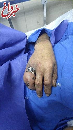 انگشترهای تنگ مردی را روانه بیمارستان کرد +‌عکس
