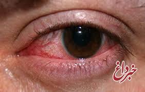 عفونت‎های چشم چه علائمی دارند؟