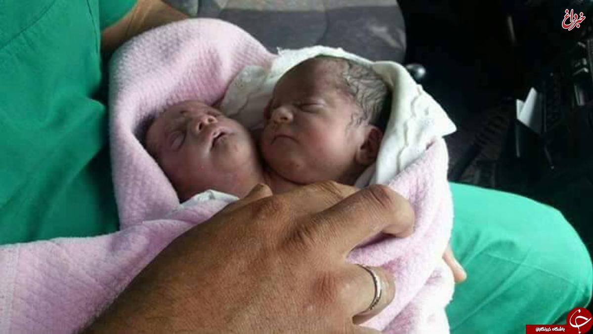 تولد یک «نوزاد دوسر» در سوریه! +عکس