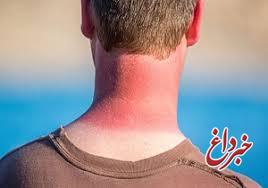 راهکار‌های اورژانسی برای درمان «آفتاب سوختگی» در تابستان