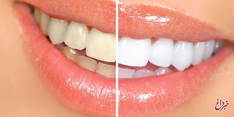 اگر در پی دندان هایی سفید و لبخندی زیبا هستید، سبزیجات و لبنیات را در رژیم غذایی روزانه خود جای دهید