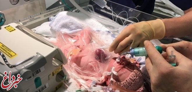 نجات جان نوزادی که قلبش بیرون بدنش بود!/همکاری گروه پزشکی ۵۰ نفره