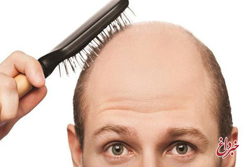 ۵۰درصد ایرانی‌ها مشکل ریزش موی سر دارند!