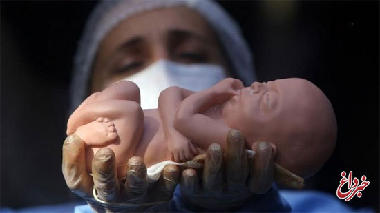 سالیانه؛ ۳۰۰ تا ۵۰۰هزار سقط جنین در ایران