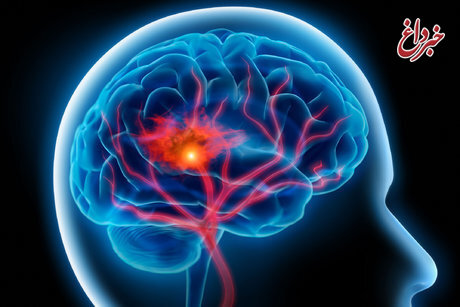 سن سکته مغزی به زیر ۵۰ سال رسید+ علایم بیماری