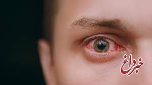 التهاب چشم یکی از نشانه‌های تهاجم کرونا است