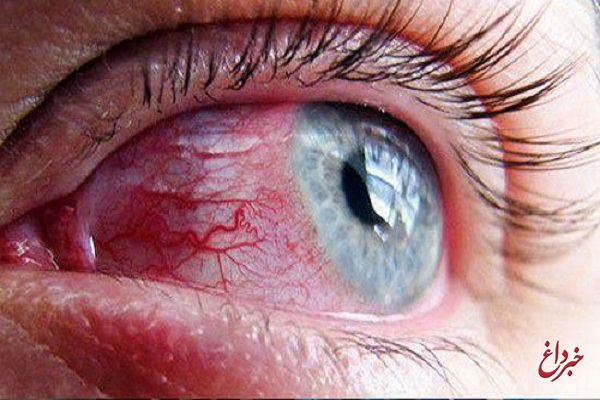 التهاب چشم یکی از نشانه‌های تهاجم کرونا است / ترشحات اشکی دقیقا همانند مخاط بینی عامل انتقال این بیماری است / ضرورت استفاده از شیلدهای محافظ چشم در محیط های پرتراکم