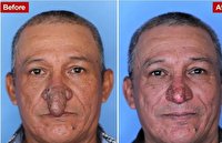 جراحی خیره‌کننده‌ی بینی یک مرد ۵۷ساله