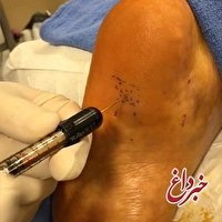 درمان یکی از بیماری‌های دردناک پا با تزریق چربی