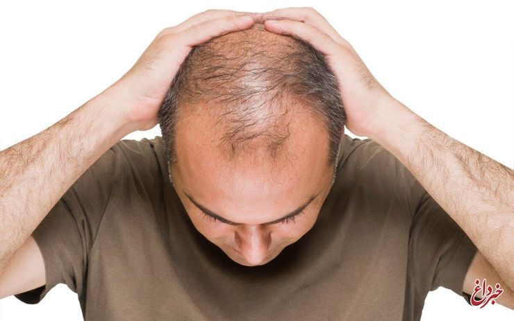 پیشگیری از ریزش موها با ۷ خوراکی موثر