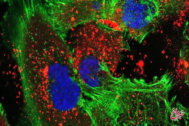 درمانی جدید برای مبارزه با سرطان مغز