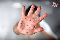 آخرین وضعیت «سرخک» در ایران؛ کودکان زیر ۵ سال سریع‌تر واکسن سرخک بزنند