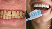 چرا دندان‌ها زرد می‌شوند و چه باید کرد؟