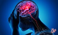 نشانه‌ها و علائم سکته مغزی چیست؟