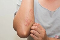 بیماری «سلیاک» چیست و چه علائمی دارد؟