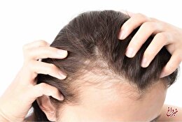 چند باور نادرست درباره ریزش مو/ درمان‌های طبیعی برای ریزش مو چقدر موثرند؟