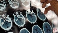 هشدار درباره شروع آلزایمر از ۴۰ سالگی/ عوامل مؤثر در پیشگیری از آلزایمر