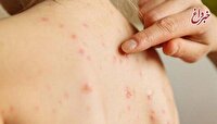 نقش آموزش عمومی و اعتمادسازی در موفقیت واکسیناسیون سرخک در کشور/ ایران، یکی از چهار کشور دارای گواهی حذف سرخک