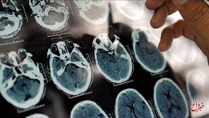 تشخیص زودهنگام آلزایمر در افراد با گوشی و ساعت هوشمند