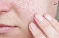 با منافذ باز پوست چه کنیم؟/ این منافذ به طور قطعی درمان می‌شوند؟