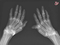 کشف صدها رشته طلای خالص در زانوی زن مبتلا به آرتروز